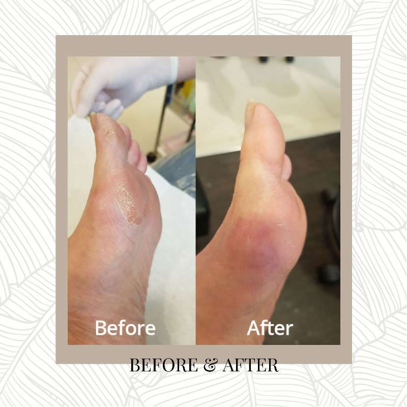 Foot callus treatment - before & after 1