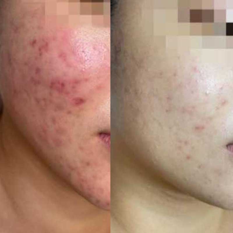 T Care Face Therapy - Before & After Model 1