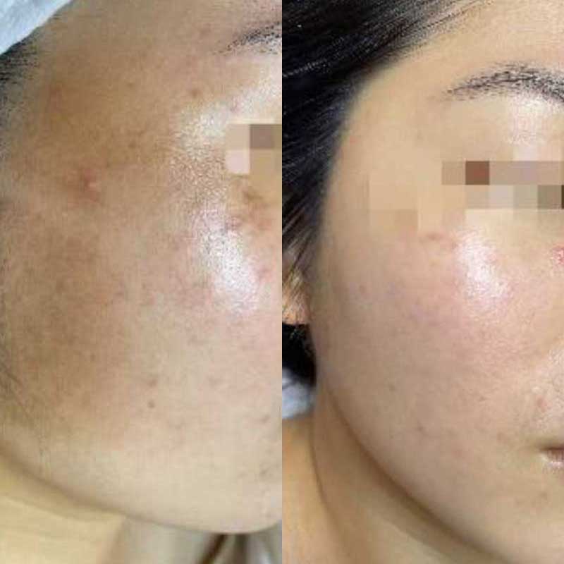 Aloe Soothing Face Treatment - Before & After 1